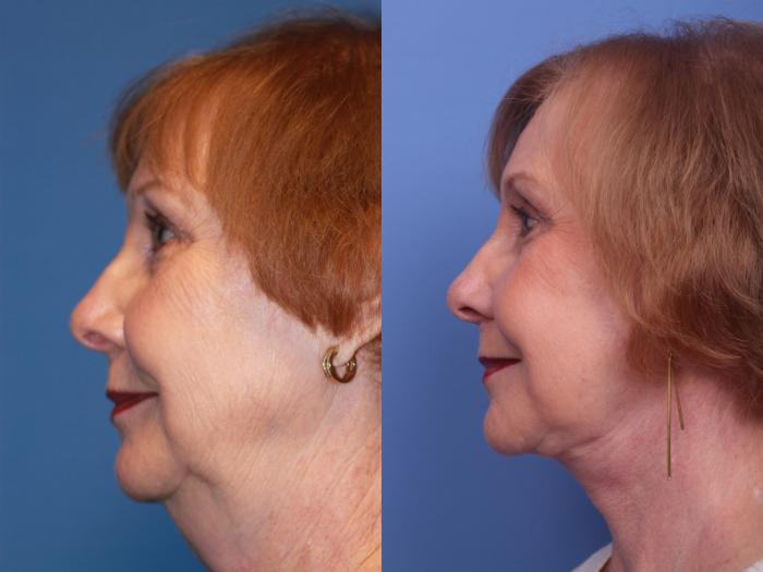 Facelift Before And After Pictures Case 181 Scottsdale Az Hobgood Facial Plastic Surgery
