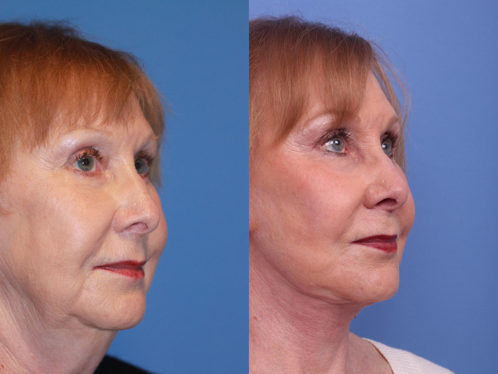 Before & After Facelift Case 181 View #3 View in Scottsdale, AZ