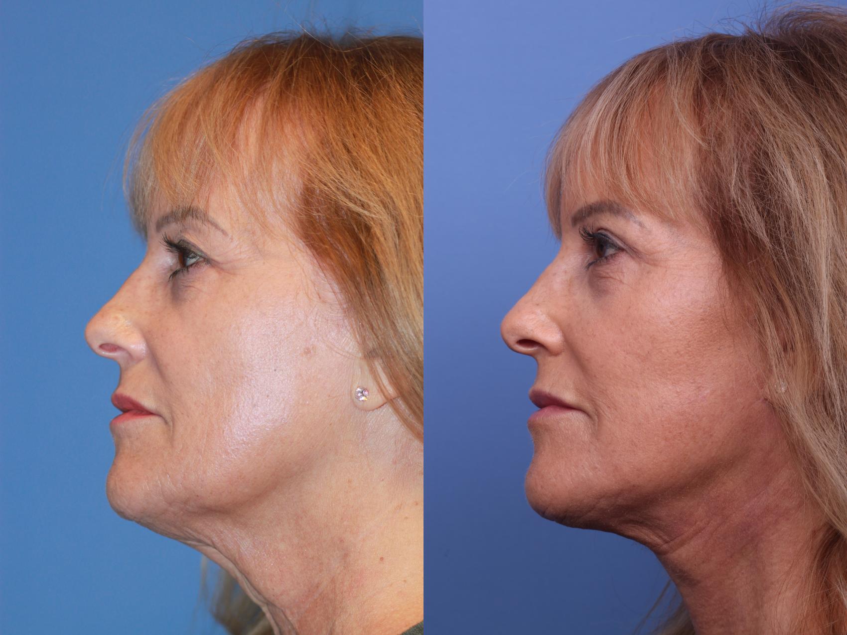 Before & After Facelift Case 184 View #2 View in Scottsdale, AZ