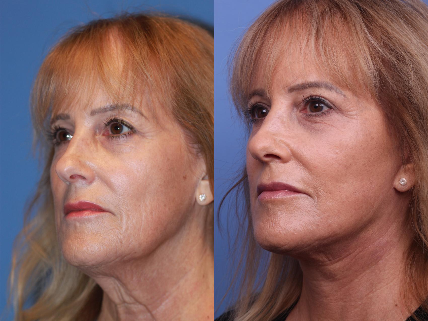 Before & After Facelift Case 184 View #3 View in Scottsdale, AZ