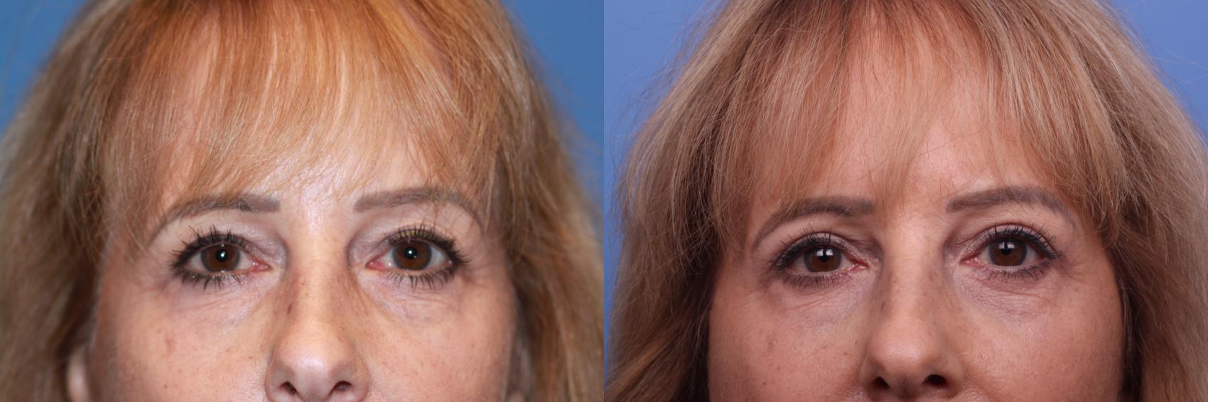 Before & After Facelift Case 184 View #4 View in Scottsdale, AZ