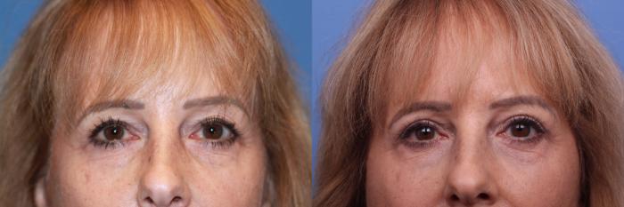 Facelift Before & After Photo | Scottsdale & Phoenix, AZ | Hobgood Facial Plastic Surgery: Todd Hobgood, MD