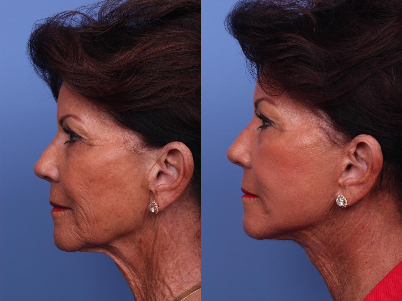 Facelift Before & After Photo | Scottsdale, AZ | Hobgood Facial Plastic Surgery: Todd Hobgood, MD