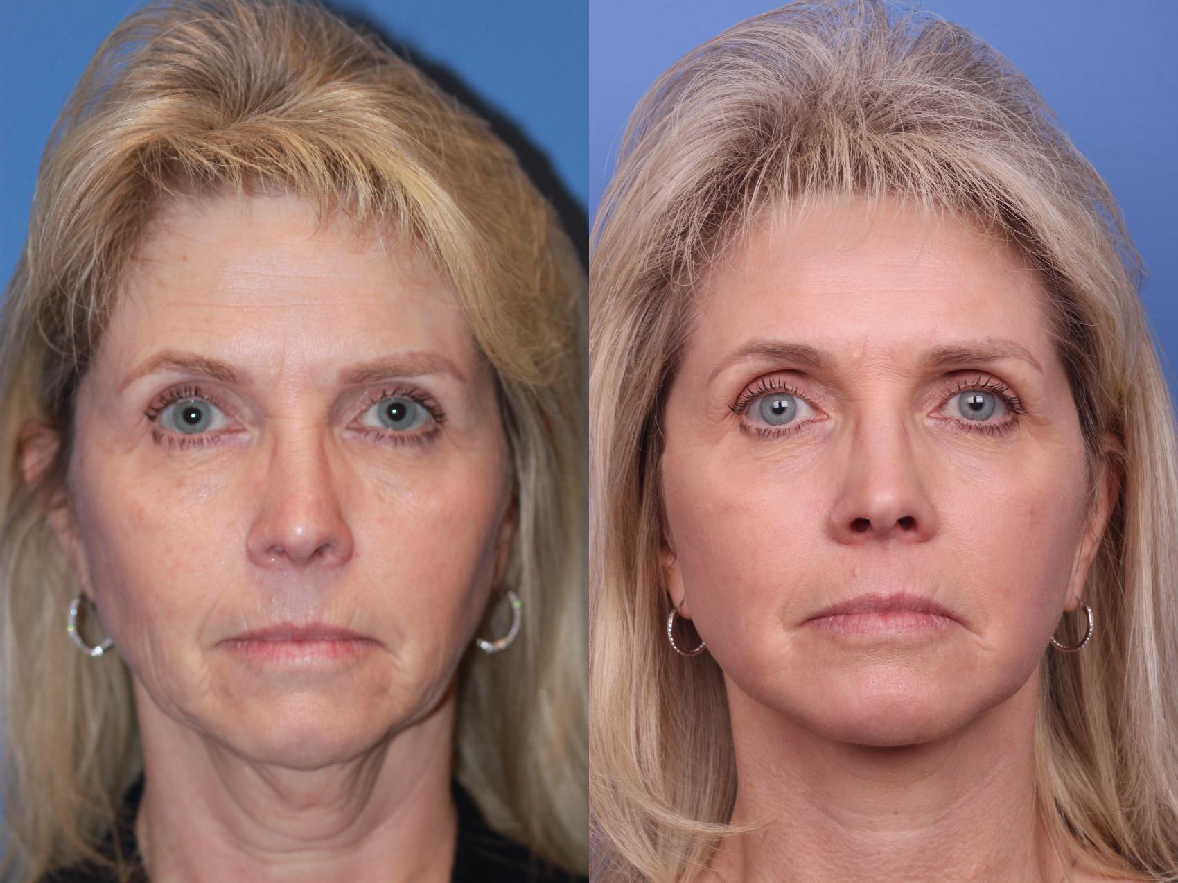 Before & After Facelift Case 194 View #1 View in Scottsdale, AZ