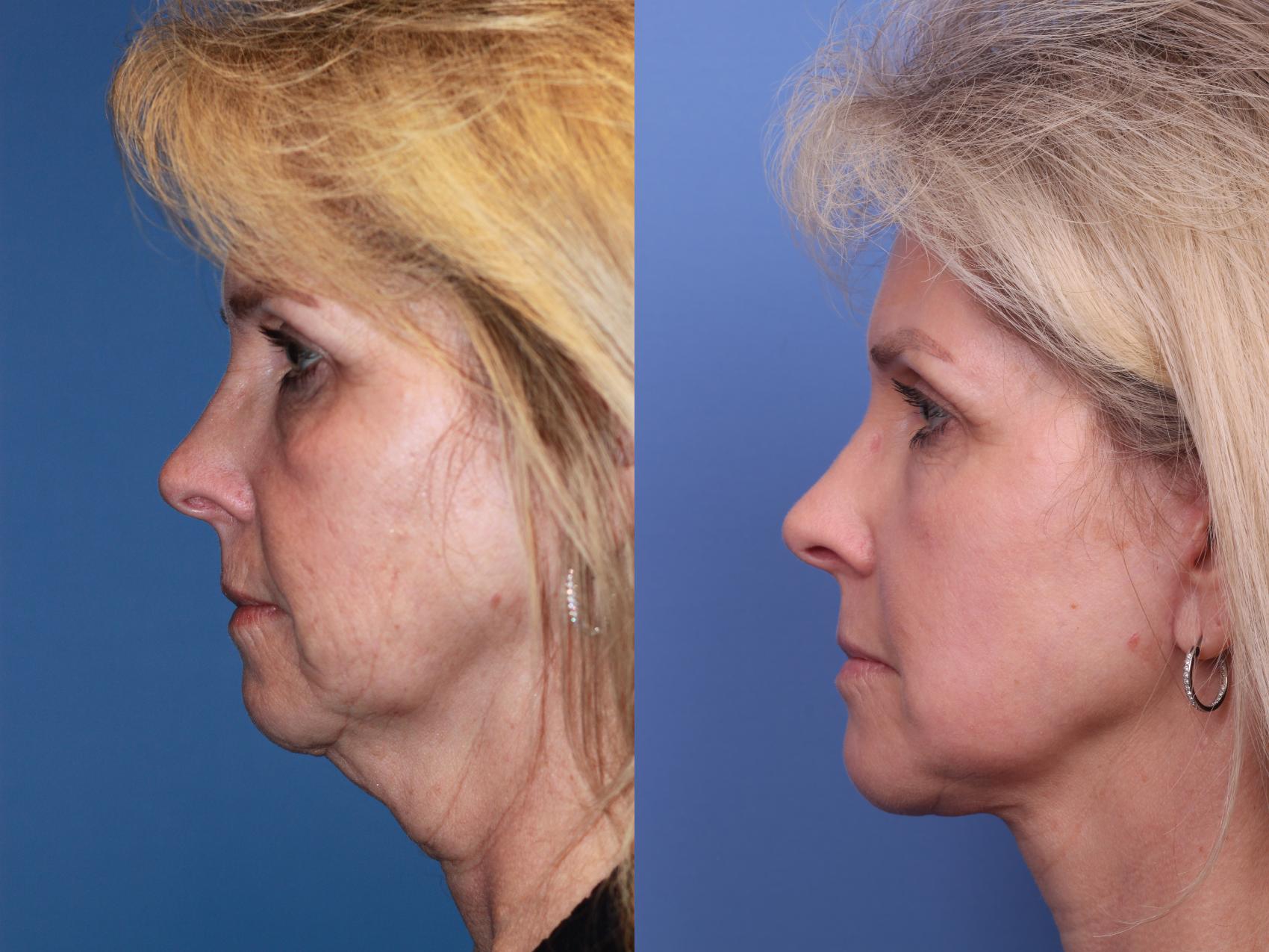 Before & After Facelift Case 194 View #2 View in Scottsdale, AZ