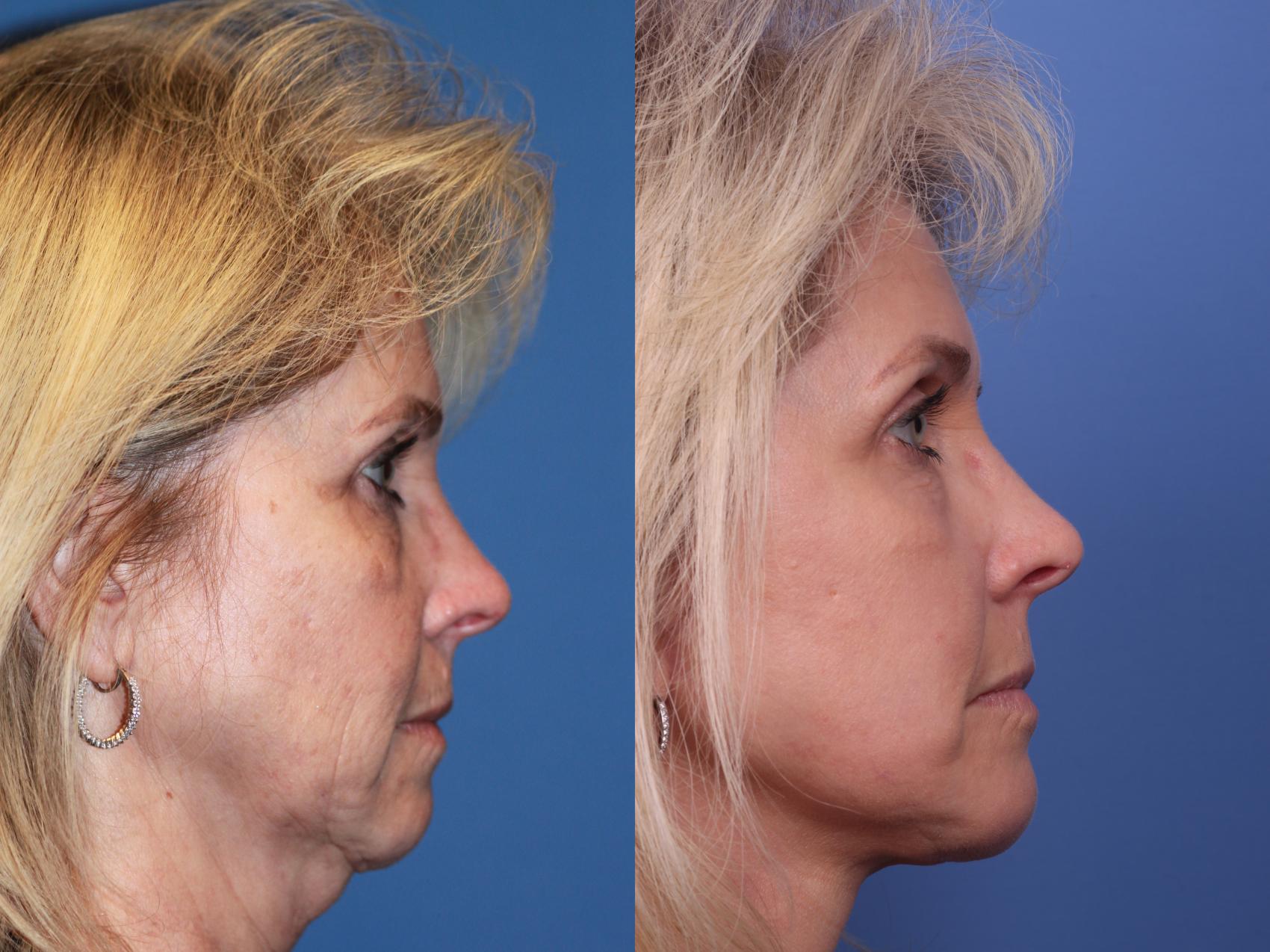 Before & After Facelift Case 194 View #4 View in Scottsdale, AZ