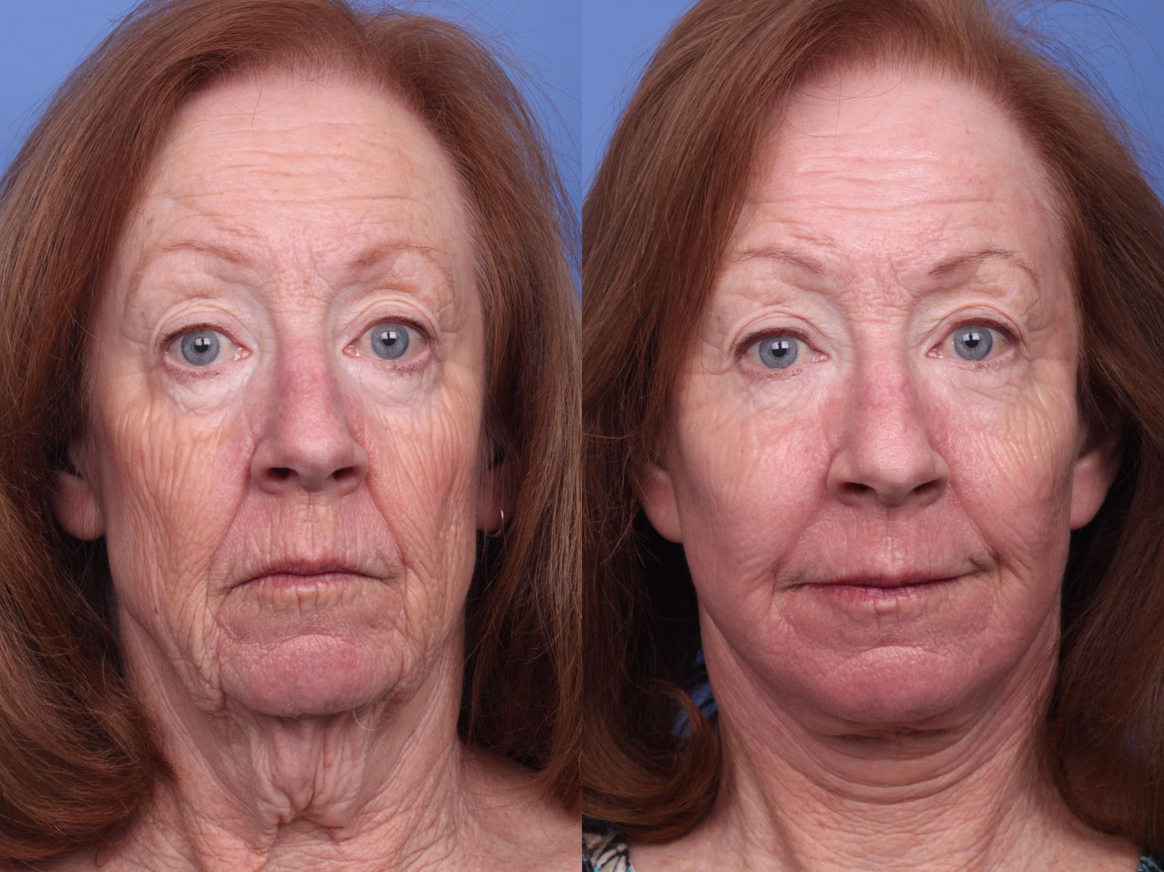 Before & After Facelift Case 240 View #2 View in Scottsdale, AZ