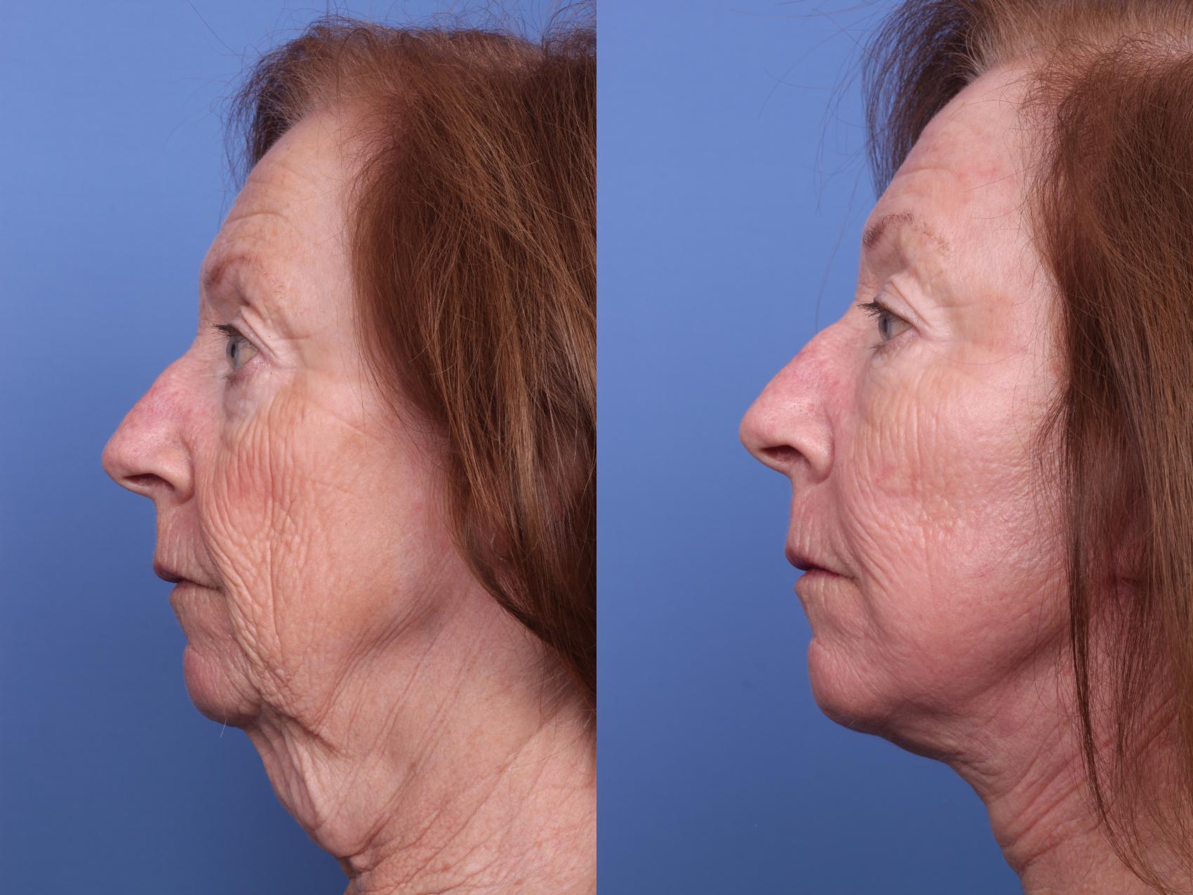 Before & After Facelift Case 240 View #3 View in Scottsdale, AZ
