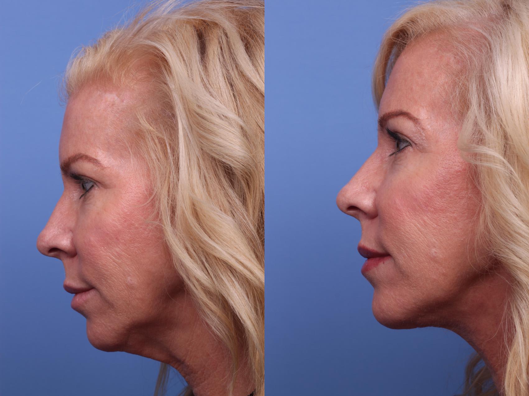 Before & After Facelift Case 247 View #2 View in Scottsdale, AZ