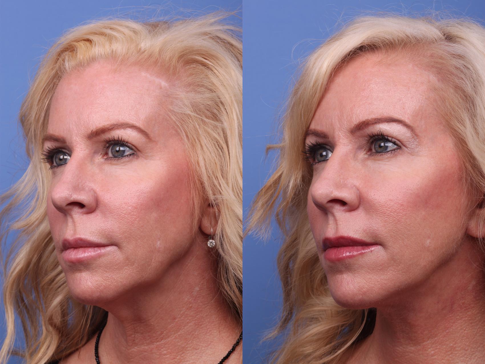 Before & After Facelift Case 247 View #3 View in Scottsdale, AZ