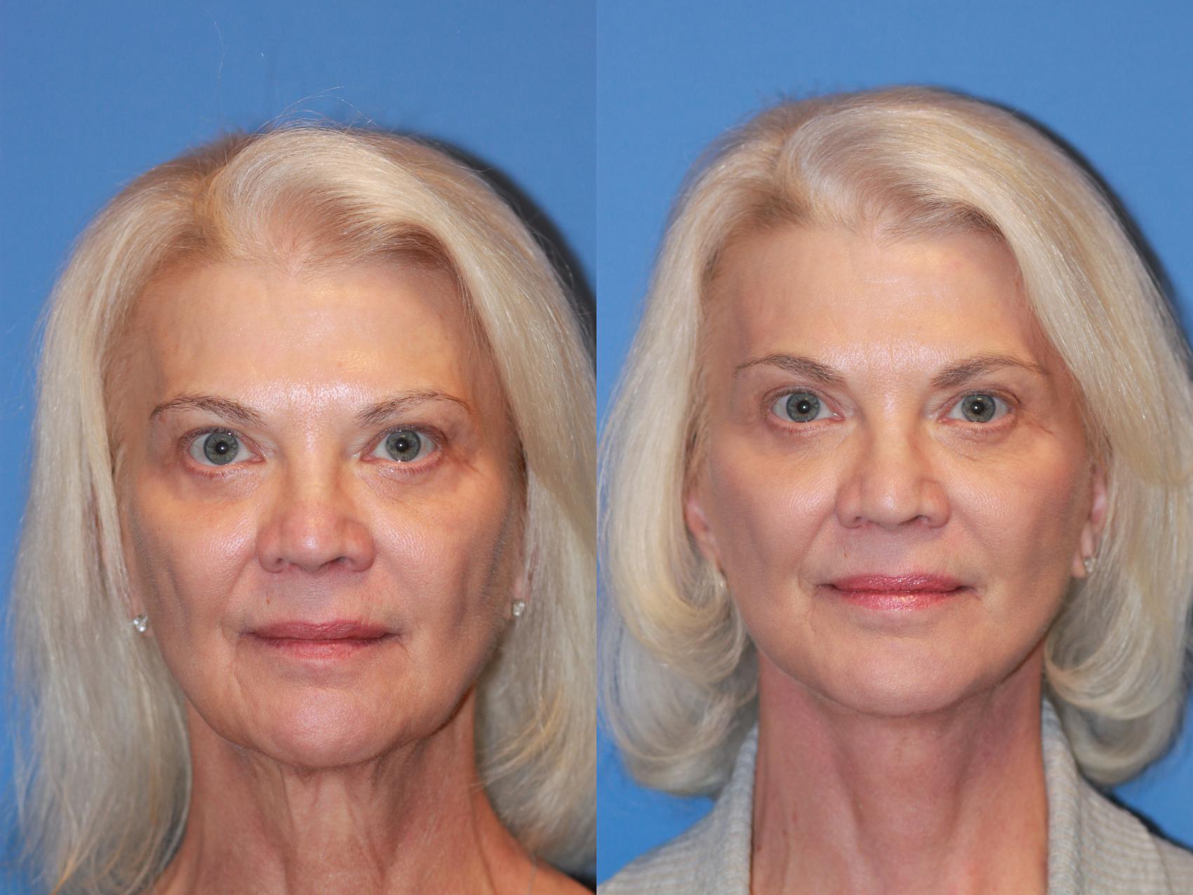 Facelift Before & After Photo | Scottsdale & Phoenix, AZ | Hobgood Facial Plastic Surgery: Todd Hobgood, MD