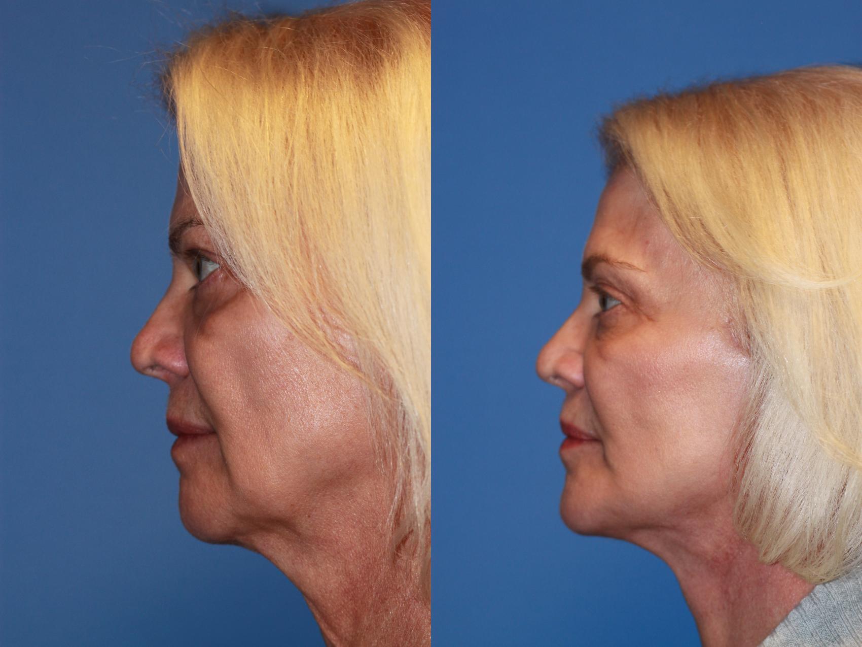 Before & After Facelift Case 252 View #2 View in Scottsdale, AZ