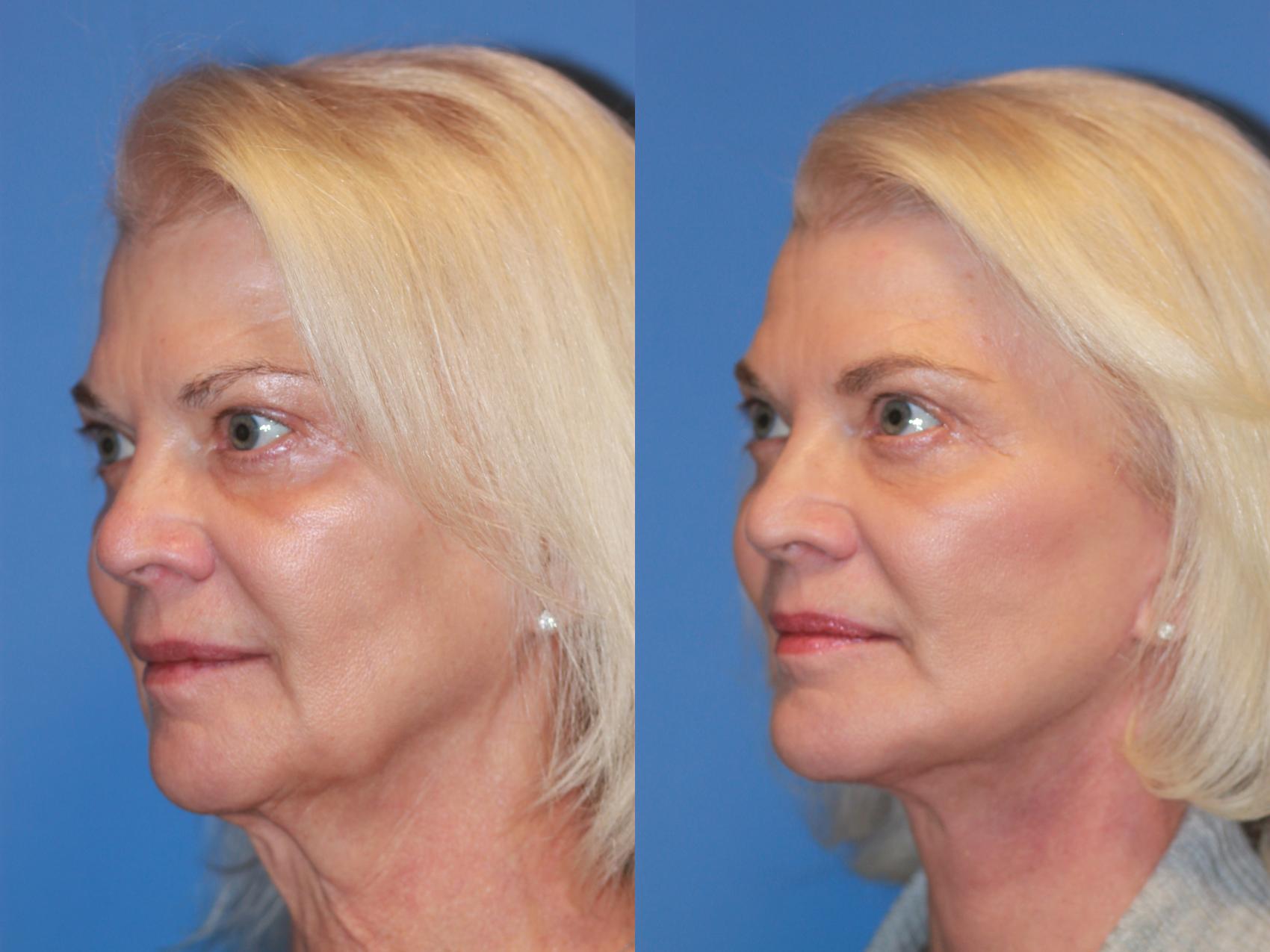 Before & After Facelift Case 252 View #3 View in Scottsdale, AZ