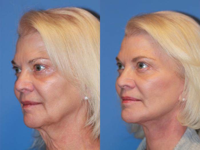 Facelift Before & After Photo | Scottsdale & Phoenix, AZ | Hobgood Facial Plastic Surgery: Todd Hobgood, MD