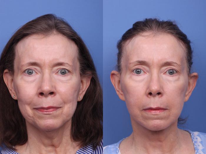 Facelift Before & After Photo | Scottsdale & Phoenix, AZ | Hobgood Facial Plastic Surgery: Todd Hobgood, MD