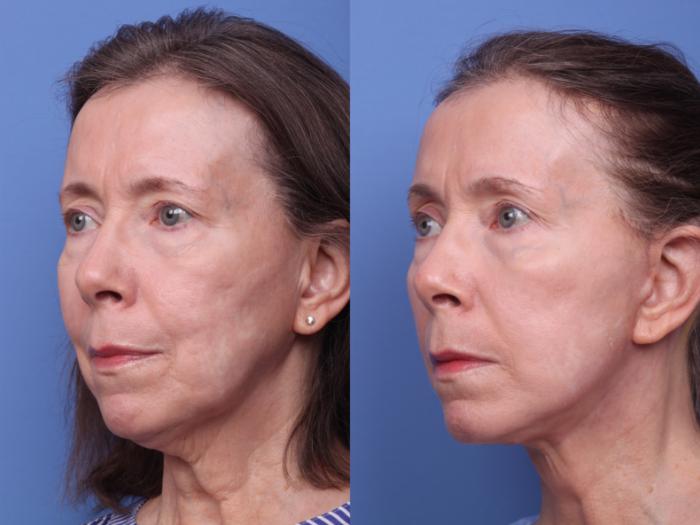 Facelift Before & After Photo | Scottsdale & Phoenix, AZ | Hobgood Facial Plastic Surgery: Todd Hobgood, MD