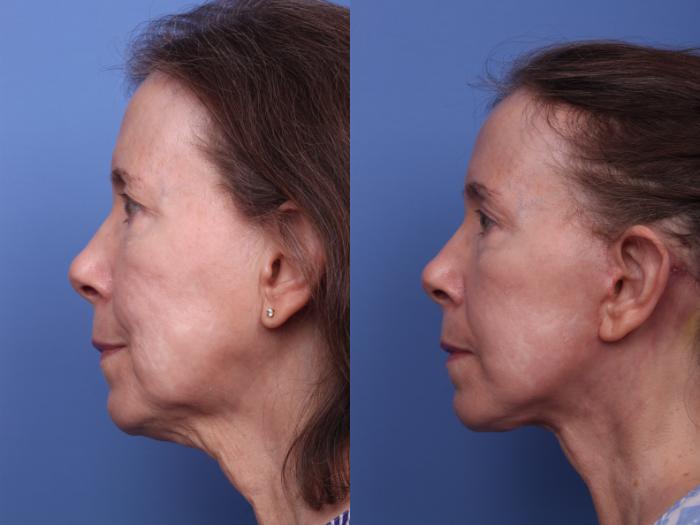 Facelift Before & After Photo | Scottsdale & Phoenix, AZ | Hobgood Facial Plastic Surgery: Todd Hobgood, MD