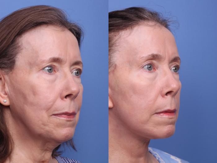 Facelift Before & After Photo | Scottsdale & Phoenix, AZ | Hobgood Facial Plastic Surgery: Todd Hobgood, MD