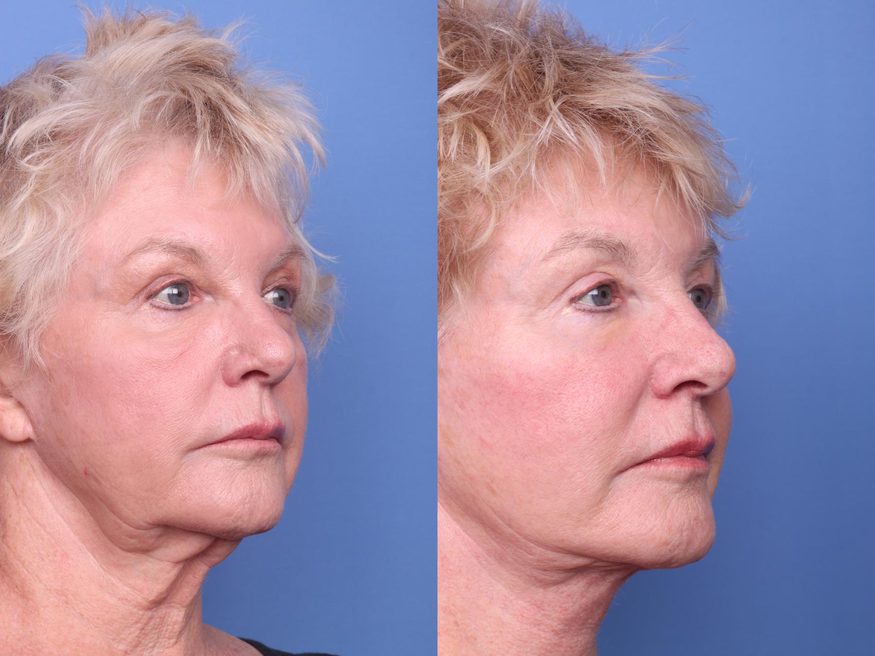 Before & After Facelift Case 259 View #2 View in Scottsdale, AZ