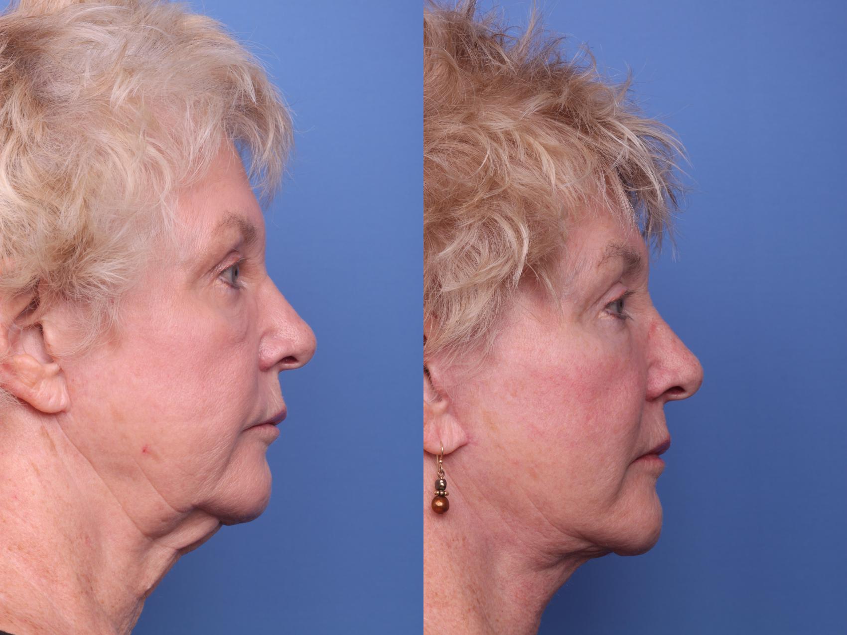 Before & After Facelift Case 259 View #3 View in Scottsdale, AZ