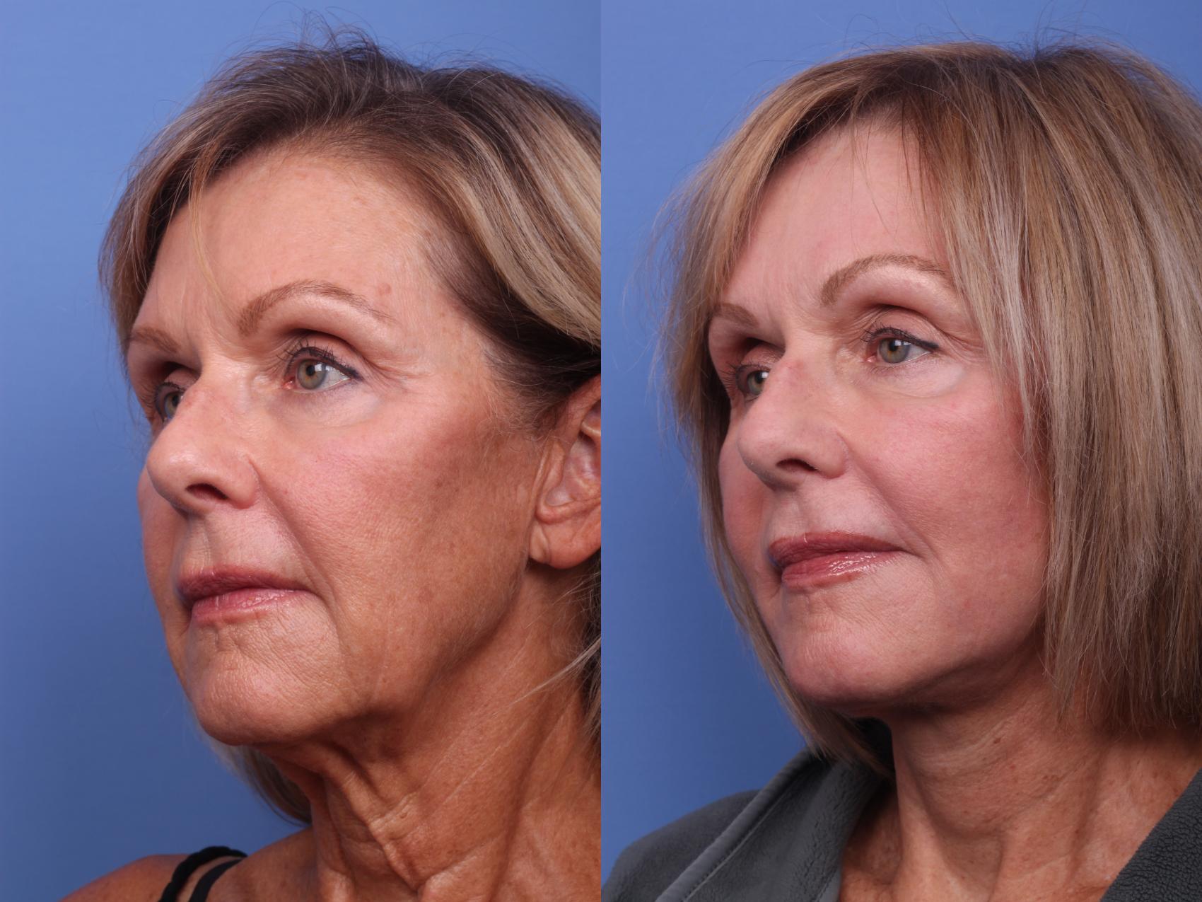 Before & After Facelift Case 275 View #2 View in Scottsdale, AZ
