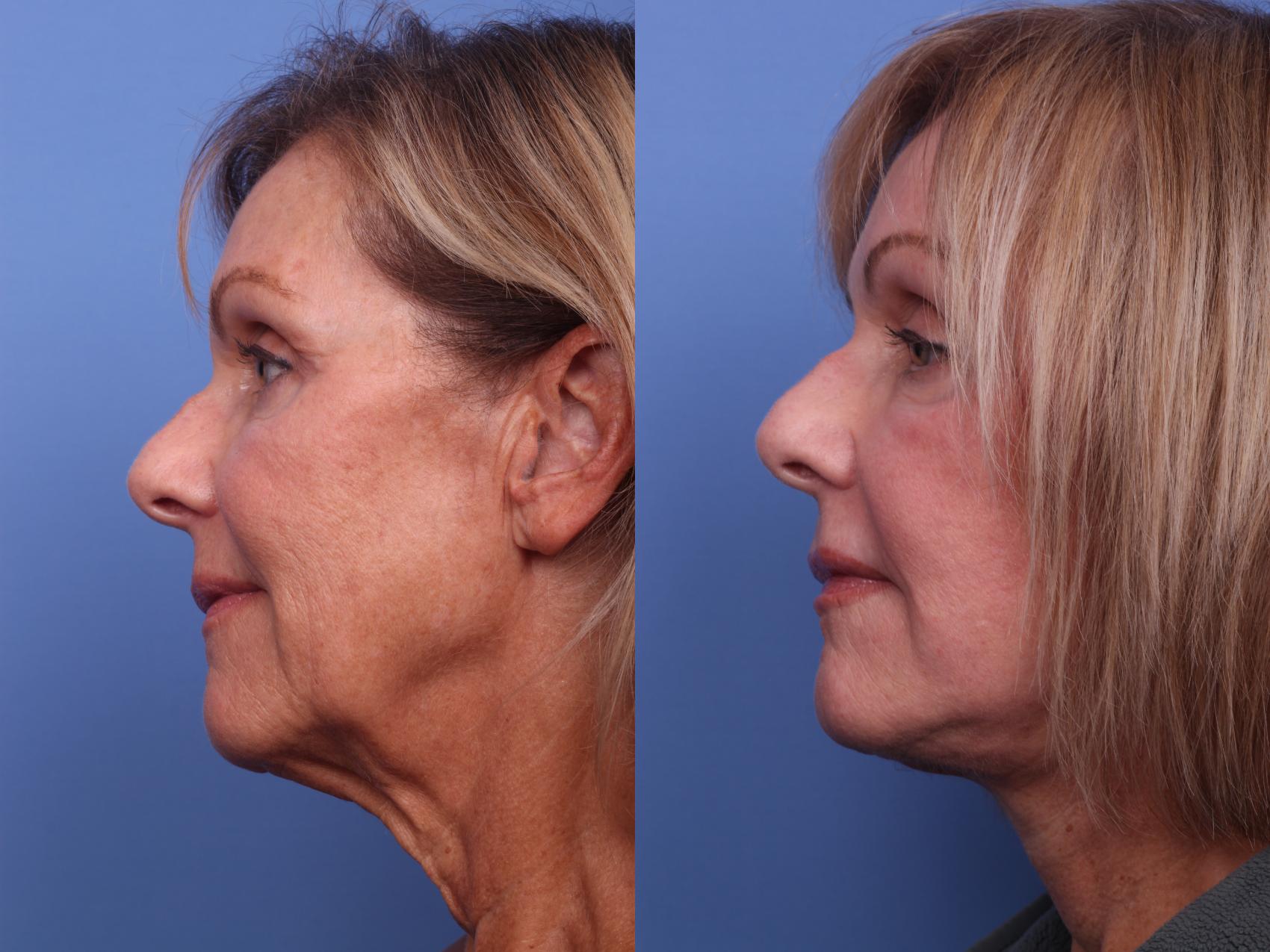 Before & After Facelift Case 275 View #3 View in Scottsdale, AZ
