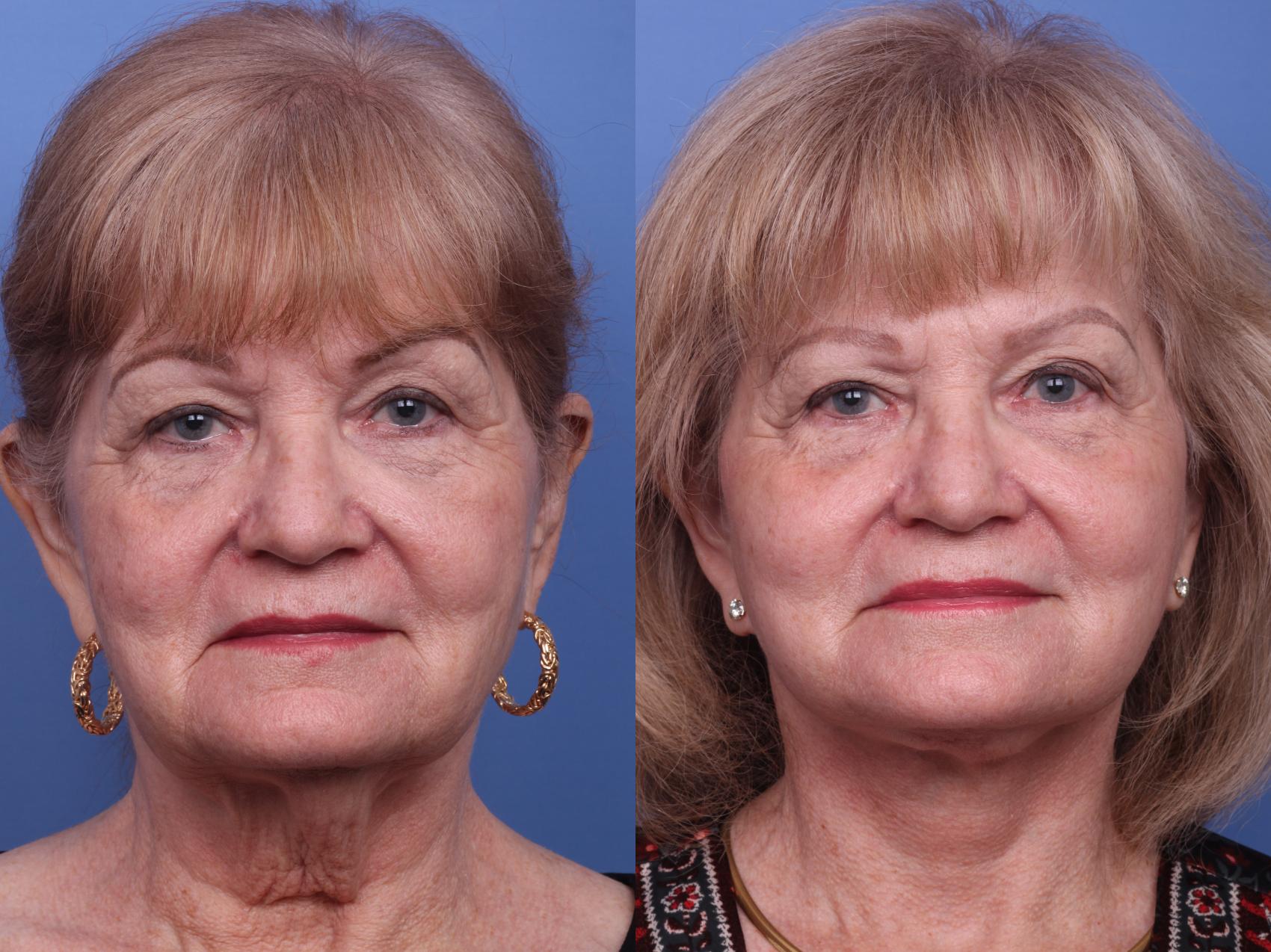 Facelift Before And After Pictures Case 279 Scottsdale Az Hobgood Facial Plastic Surgery