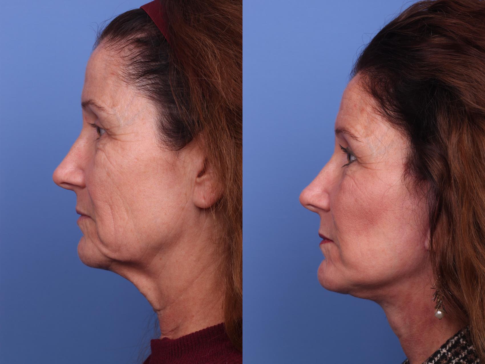 Before & After Facelift Case 285 View #2 View in Scottsdale, AZ