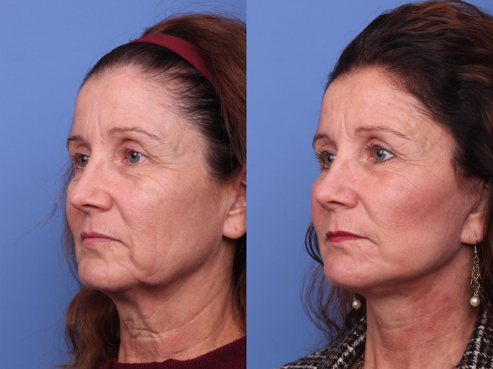 Before & After Facelift Case 285 View #3 View in Scottsdale, AZ
