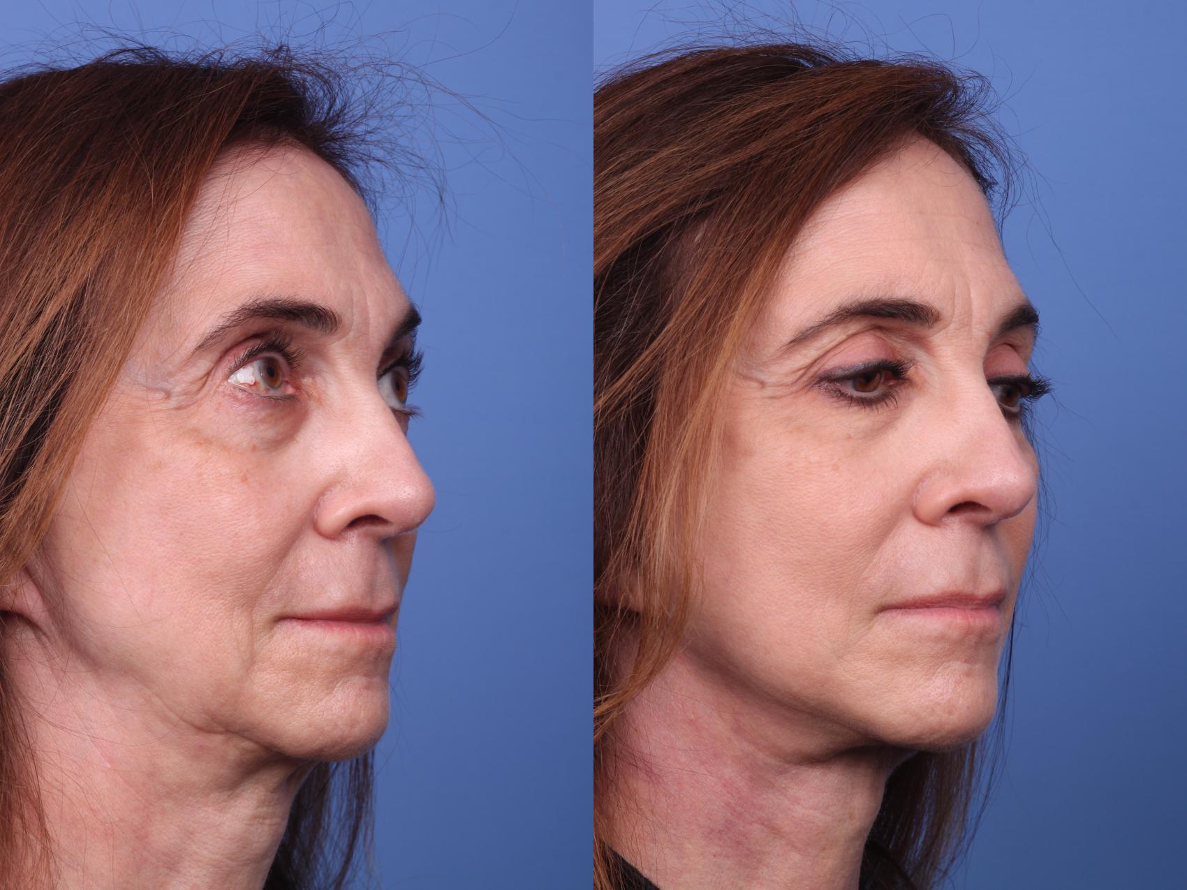 Before & After Facelift Case 302 View #2 View in Scottsdale, AZ