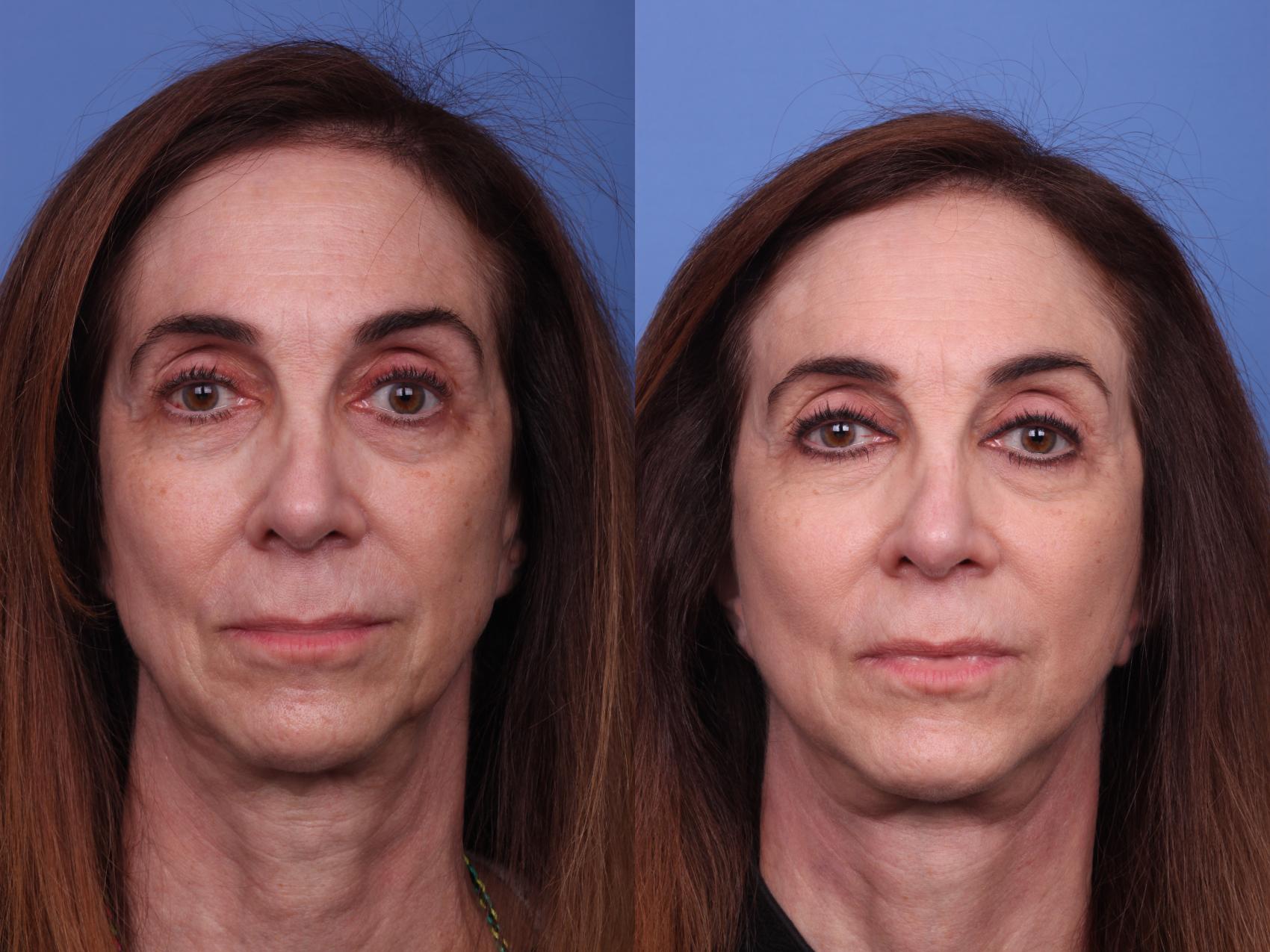 Before & After Facelift Case 302 View #3 View in Scottsdale, AZ