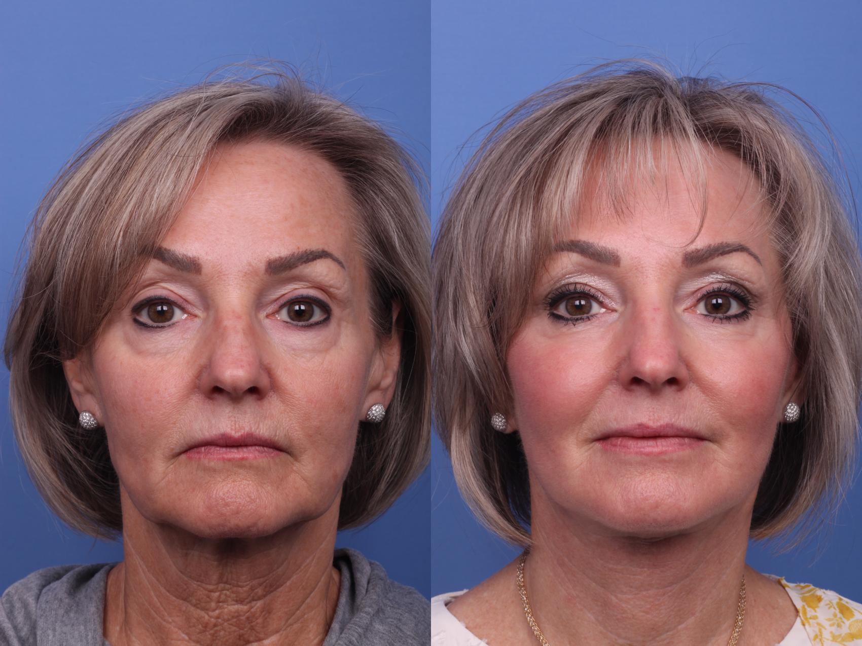 Before & After Facelift Case 312 View #1 View in Scottsdale, AZ