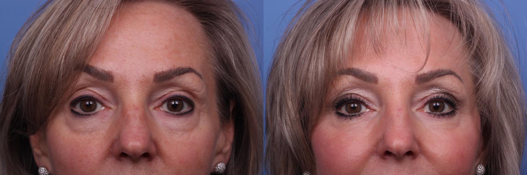 Before & After Facelift Case 312 View #2 View in Scottsdale, AZ