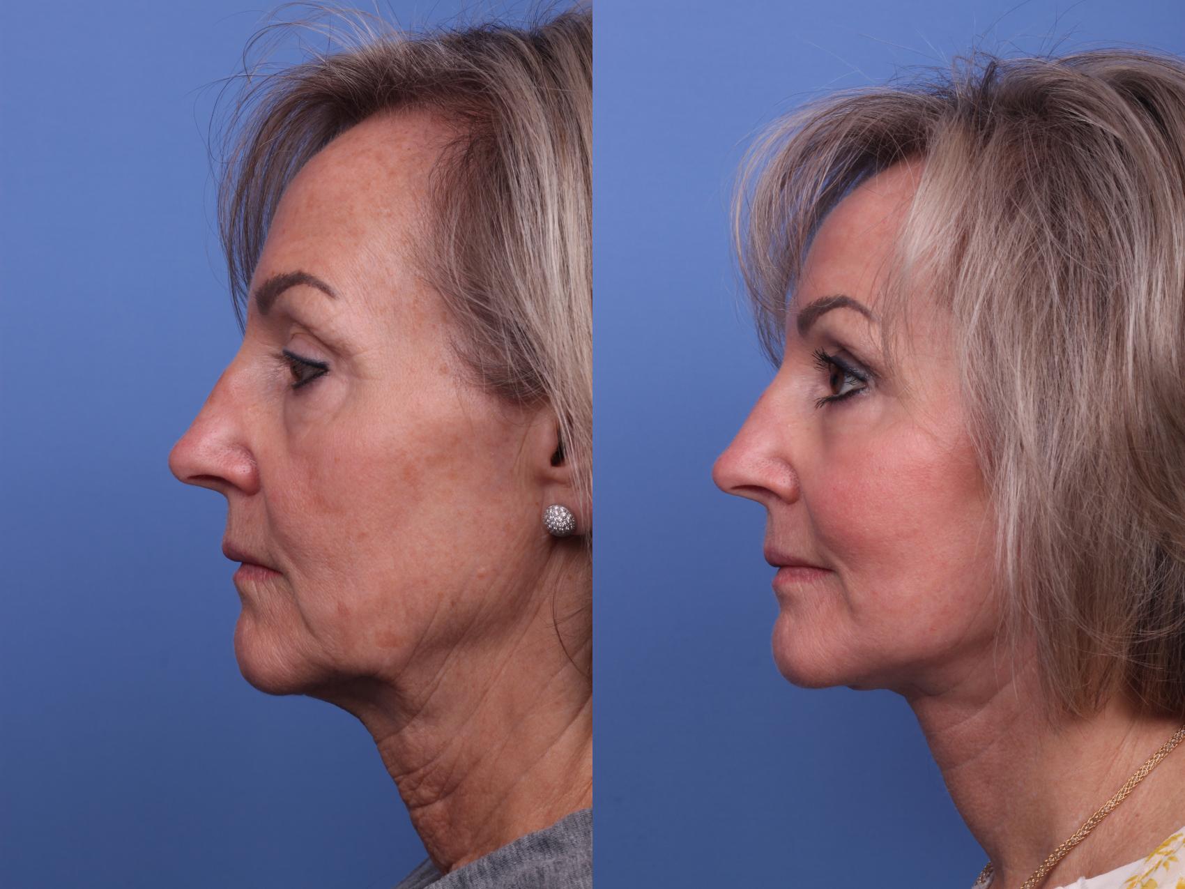 Before & After Facelift Case 312 View #3 View in Scottsdale, AZ