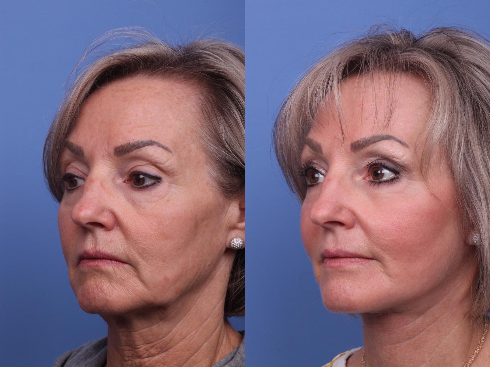 Before & After Facelift Case 312 View #4 View in Scottsdale, AZ