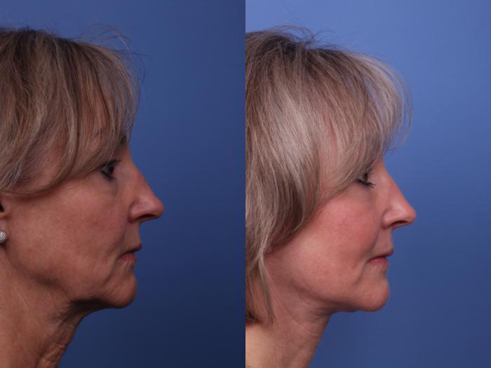 Facelift Before & After Photo | Scottsdale & Phoenix, AZ | Hobgood Facial Plastic Surgery: Todd Hobgood, MD