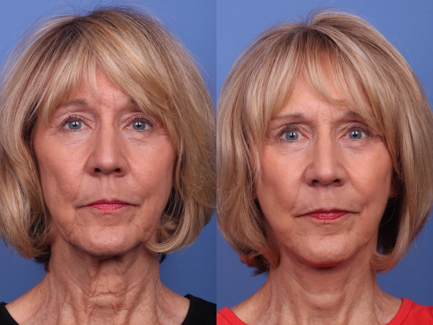 Facelift Before & After Photo | Scottsdale & Phoenix, AZ | Hobgood Facial Plastic Surgery: Todd Hobgood, MD