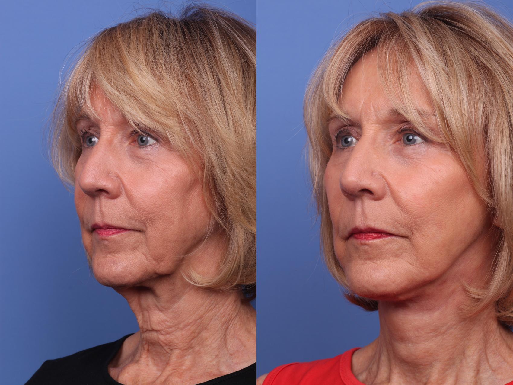 Facelift Before & After Photo | Scottsdale & Phoenix, AZ | Hobgood Facial Plastic Surgery: Todd Hobgood, MD