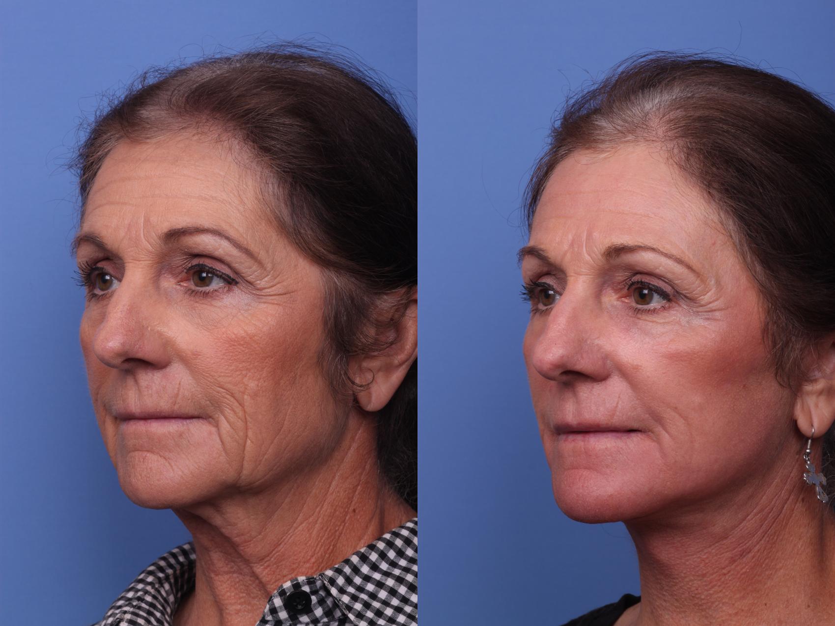 Before & After Facelift Case 318 View #2 View in Scottsdale, AZ