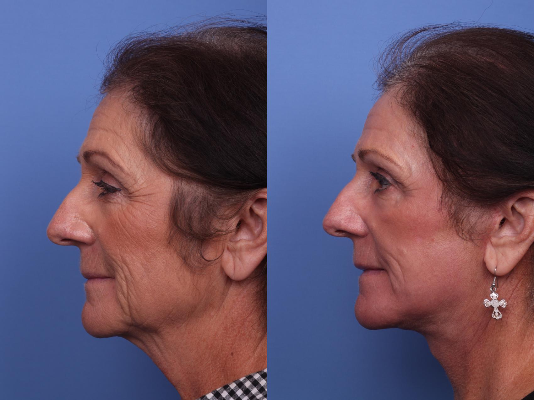 Before & After Facelift Case 318 View #3 View in Scottsdale, AZ