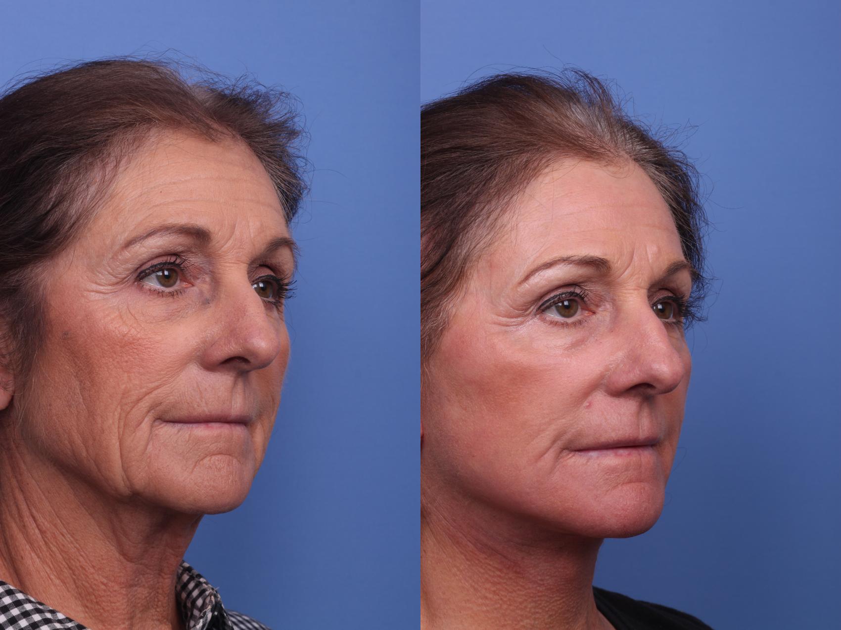 Before & After Facelift Case 318 View #4 View in Scottsdale, AZ