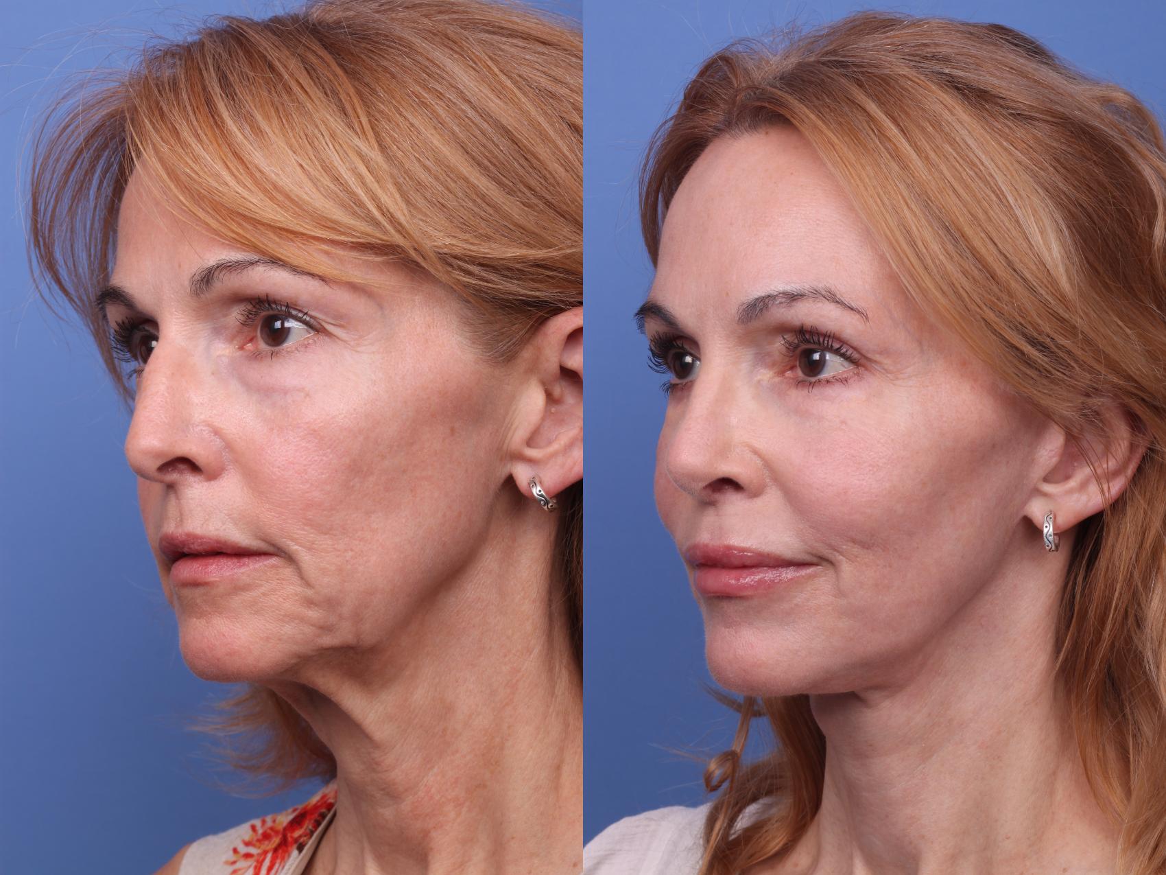 Before & After Facelift Case 342 Left Oblique View in Scottsdale, AZ