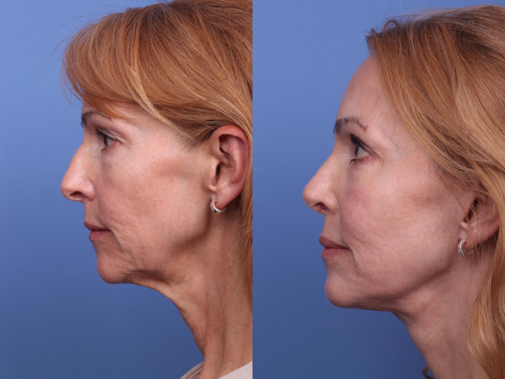 Before & After Facelift Case 342 Left Side View in Scottsdale, AZ