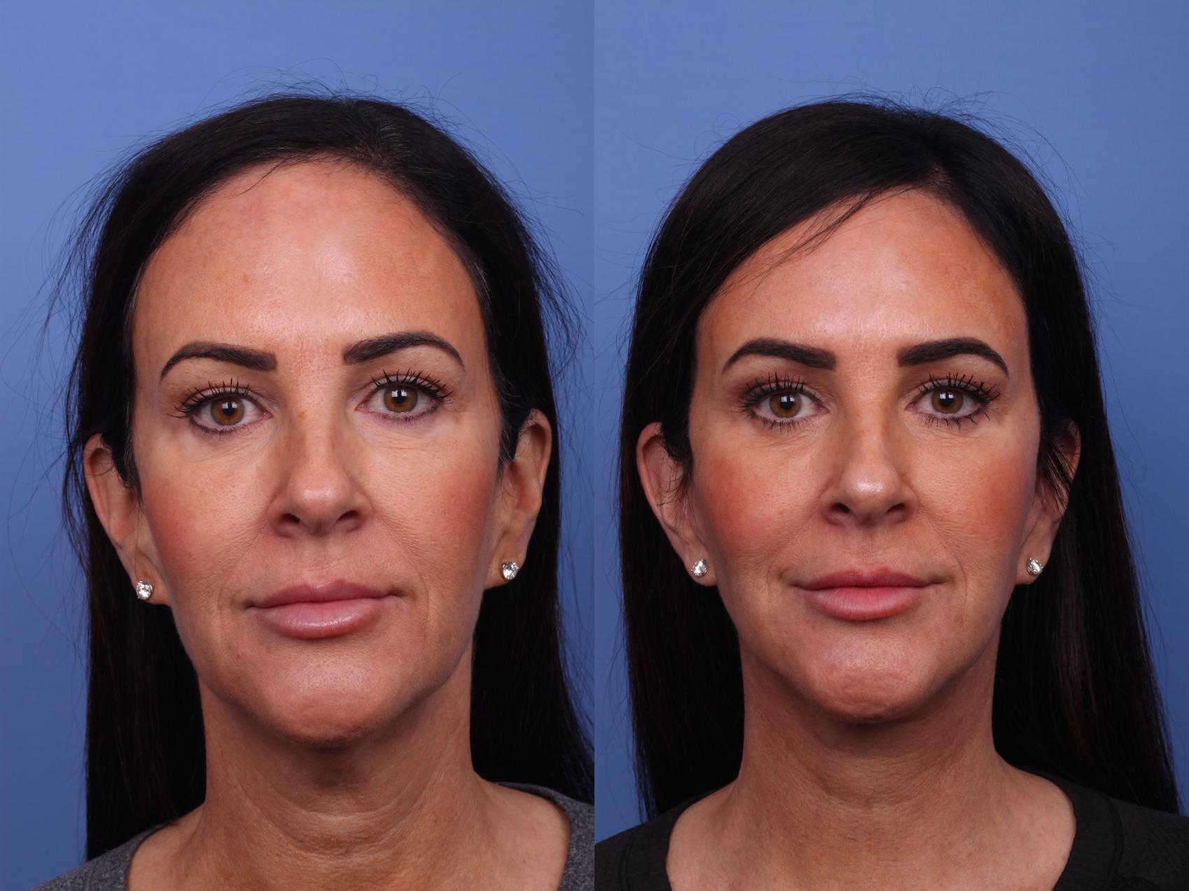 Before & After Facelift Case 351 Front View in Scottsdale, AZ