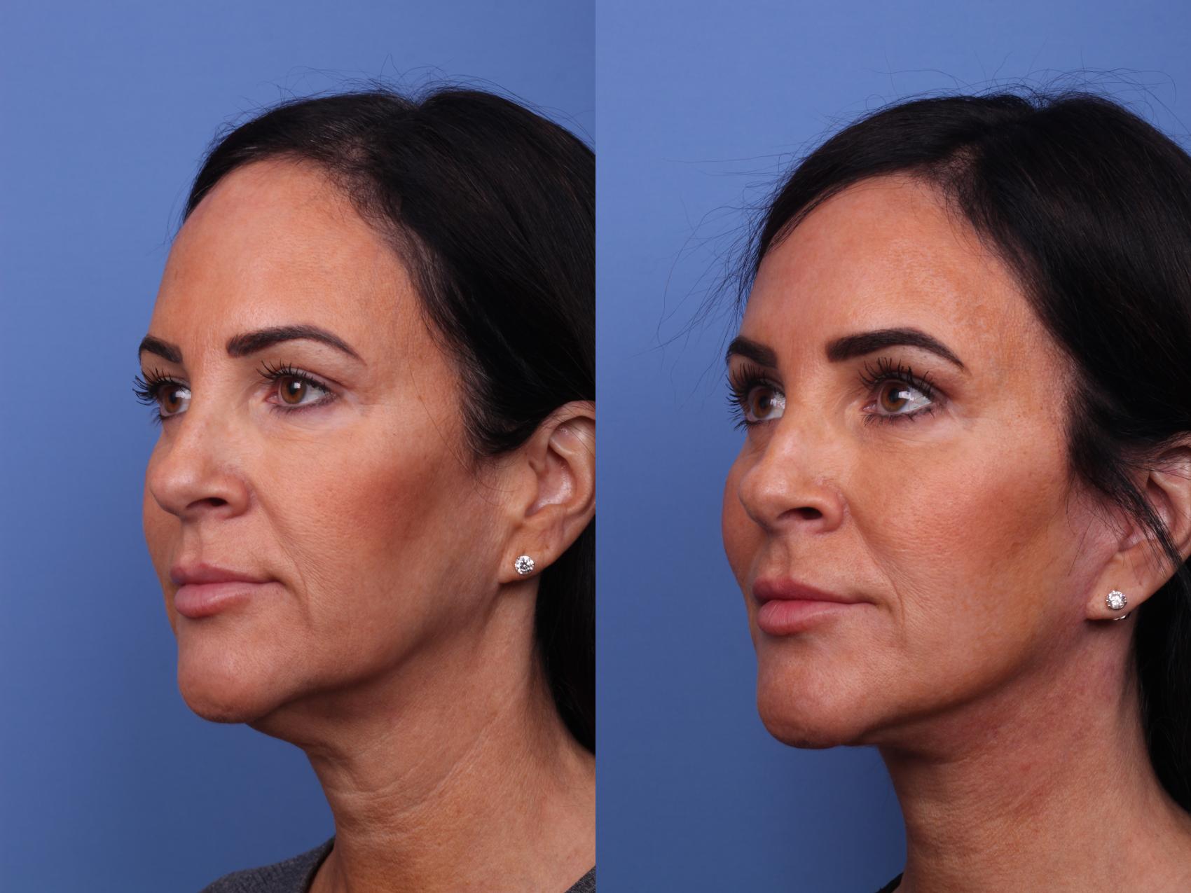 Before & After Facelift Case 351 Left Oblique View in Scottsdale, AZ