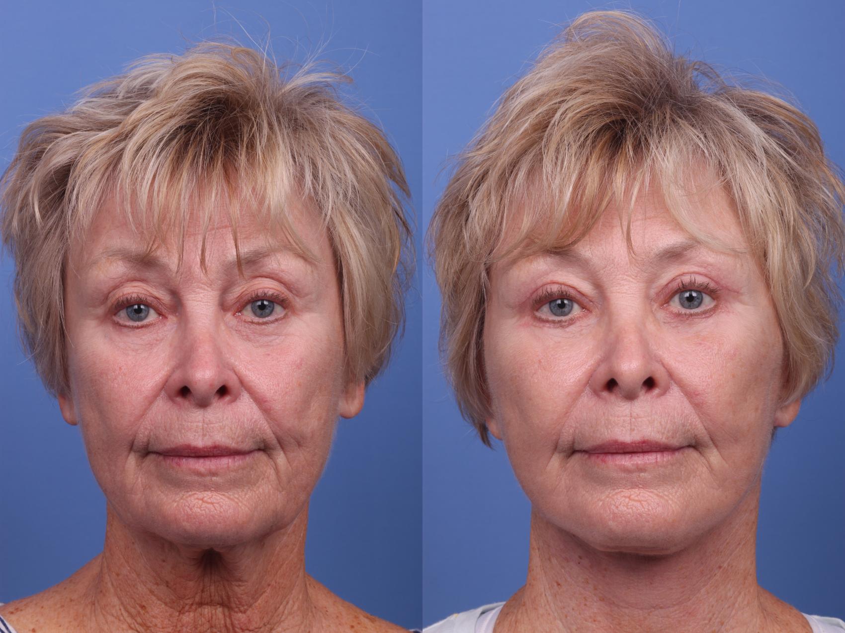 Before & After Facelift Case 361 Front View in Scottsdale, AZ