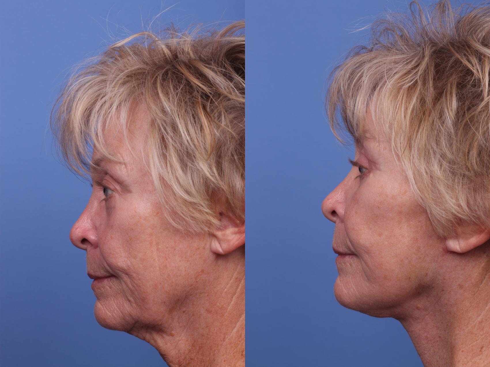 Before & After Facelift Case 361 Left Side View in Scottsdale, AZ
