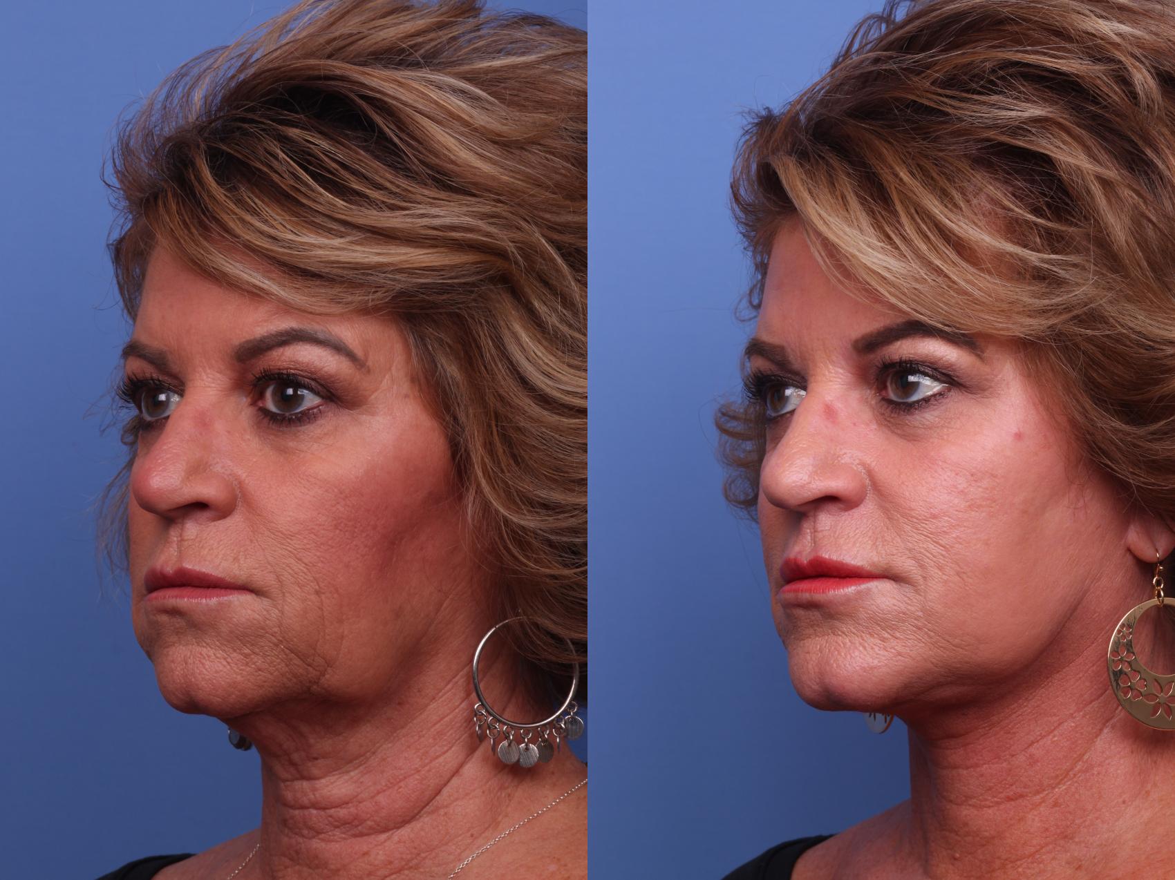 Before & After Facelift Case 365 Left Oblique View in Scottsdale, AZ