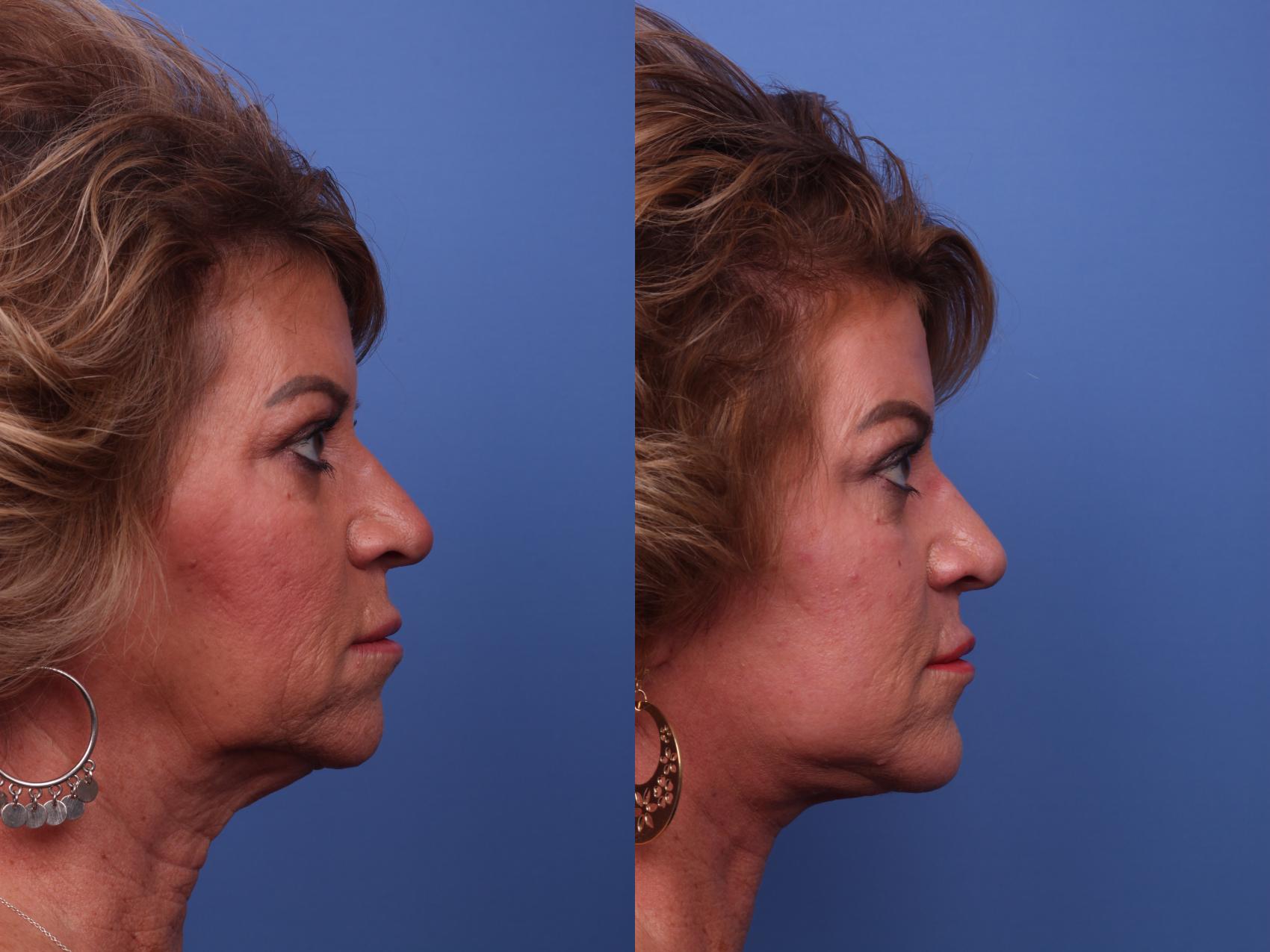 Before & After Facelift Case 365 Right Side View in Scottsdale, AZ