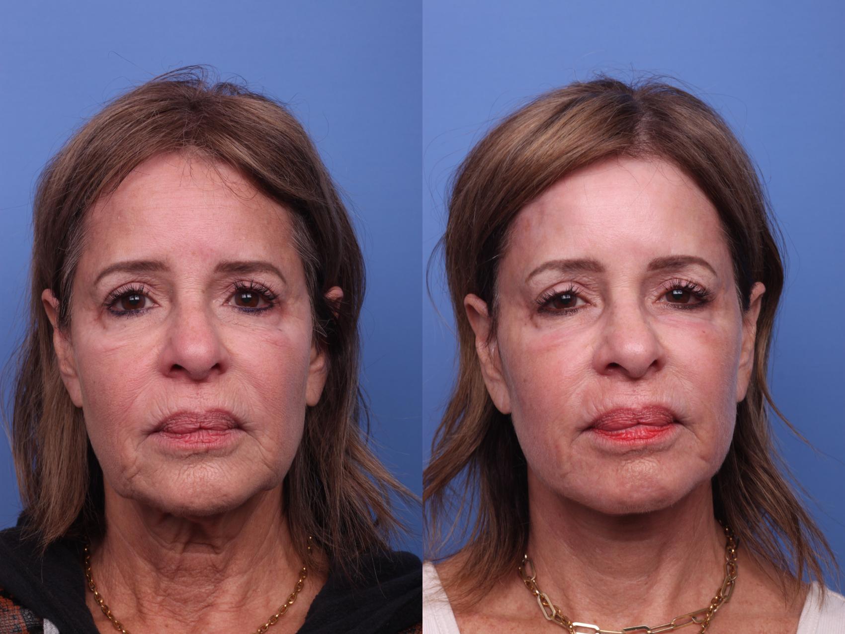 Before & After Facelift Case 367 Front View in Scottsdale, AZ